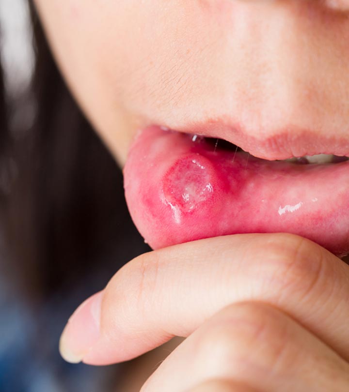How To Use Honey To Heal Canker Sores?