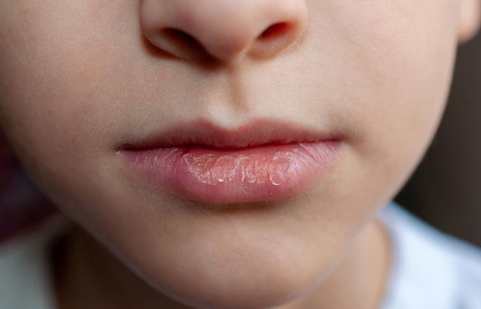 Close-up of dry, chapped lips caused by camphor.