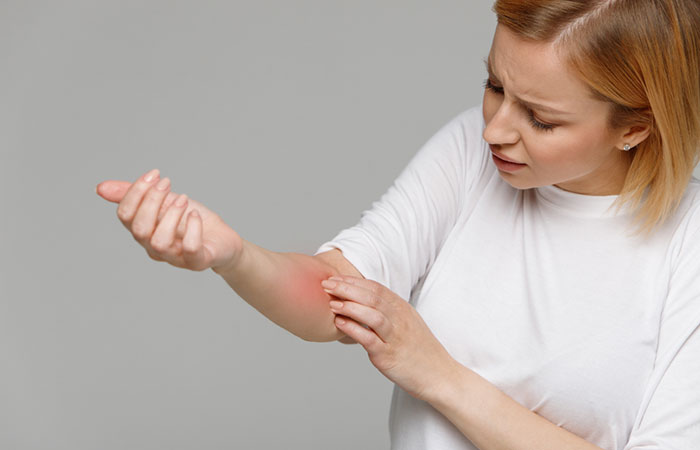 Woman experiences red rashes due to side effects of camphor.