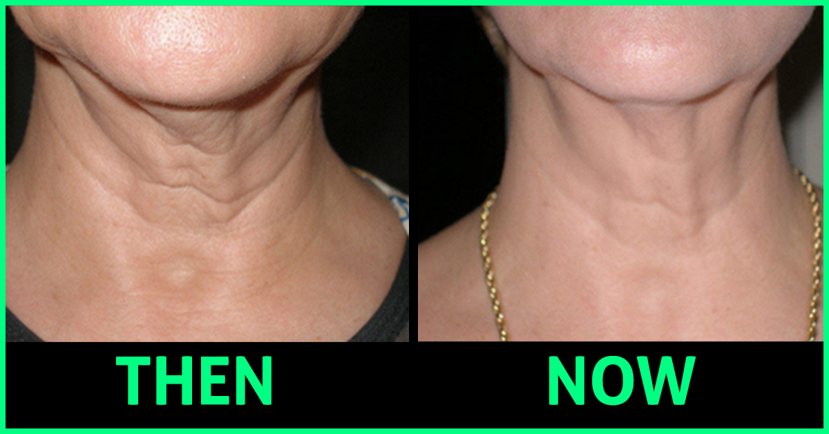 How To Tighten Your Neck Skin Naturally