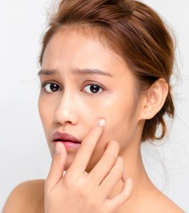 Can Mederma Be Used To Treat Acne Scars?