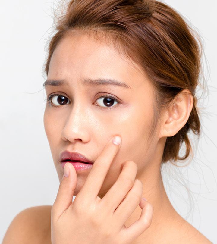 Mederma può essere usato per trattare le cicatrici da acne?