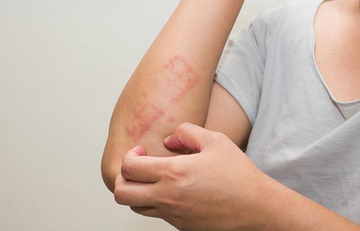 Allergic reactions to irritants may cause runner’s itch