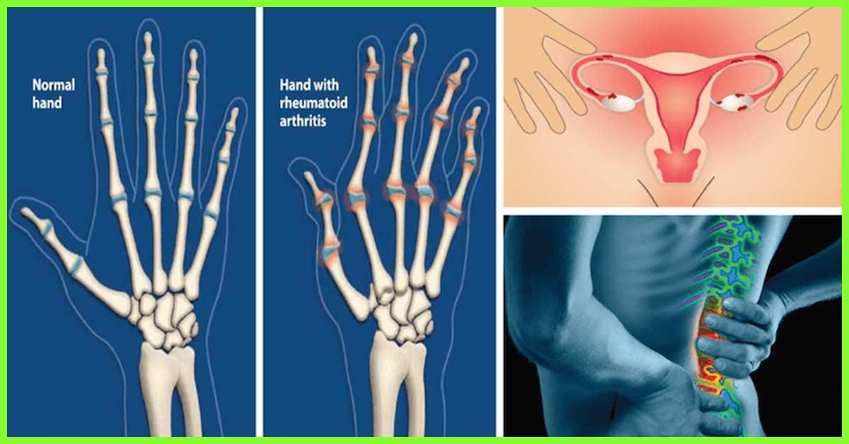 How To Use Castor Oil To Treat Arthritis?