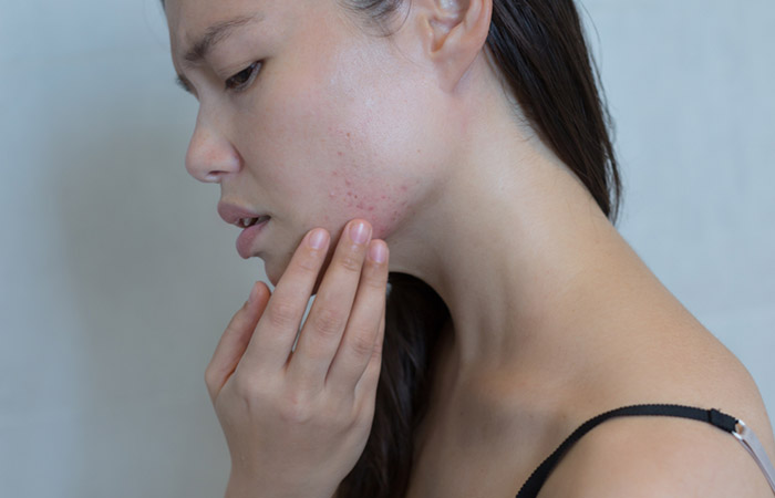 Tea tree oil may can limit the occurrence of acne breakouts