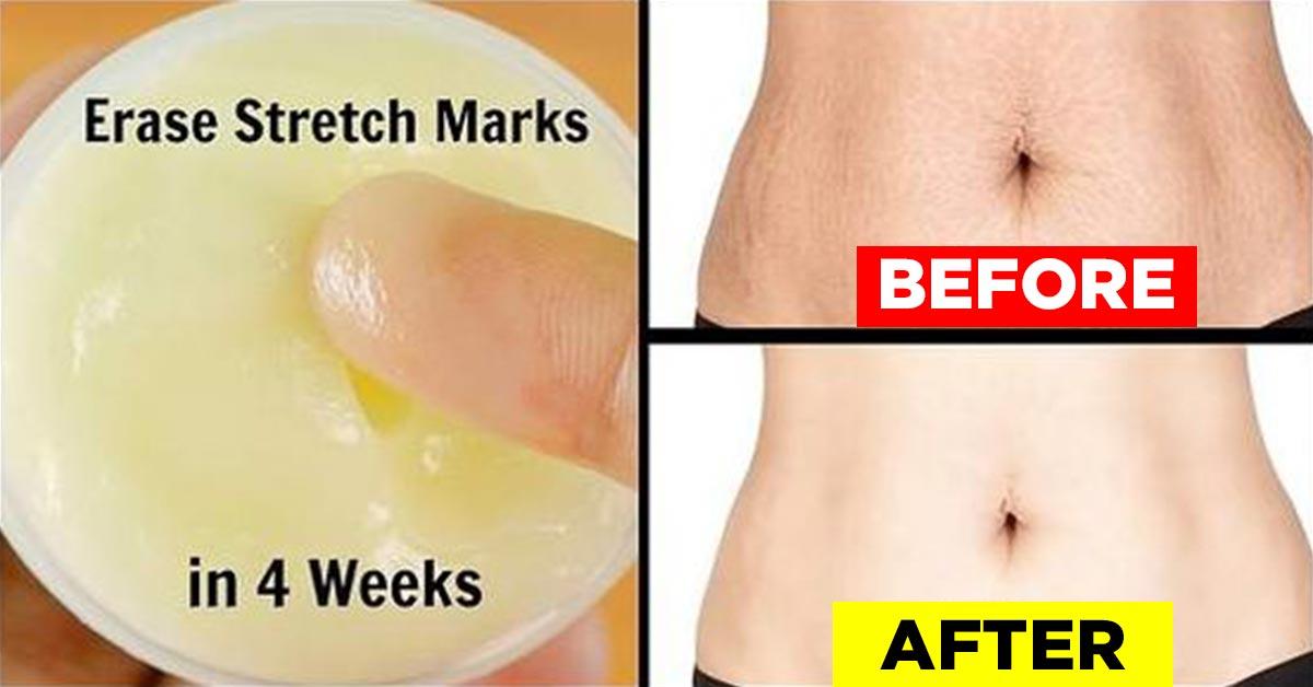 How to Get Rid of Stretch Marks, According to Dermatologists