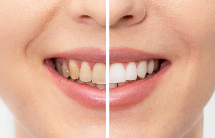 Before and after images of tooth erosion due to lemon tea
