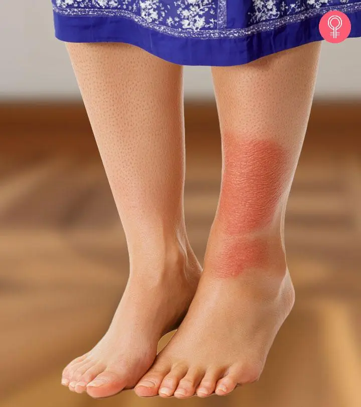 Cellulitis Treatment Without Antibiotics