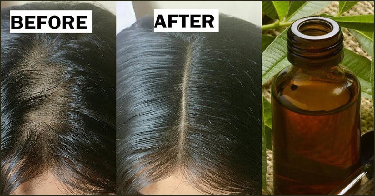 Can Coconut Oil Kill Lice 