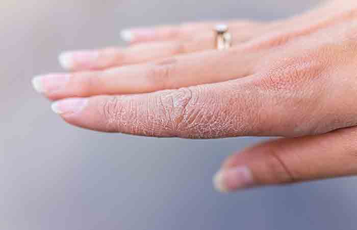 Closeup of a hand with extremely dry skin