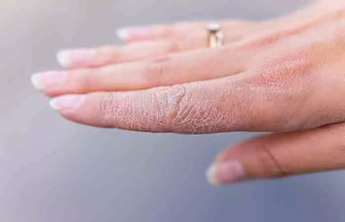 Closeup of a hand with extremely dry skin