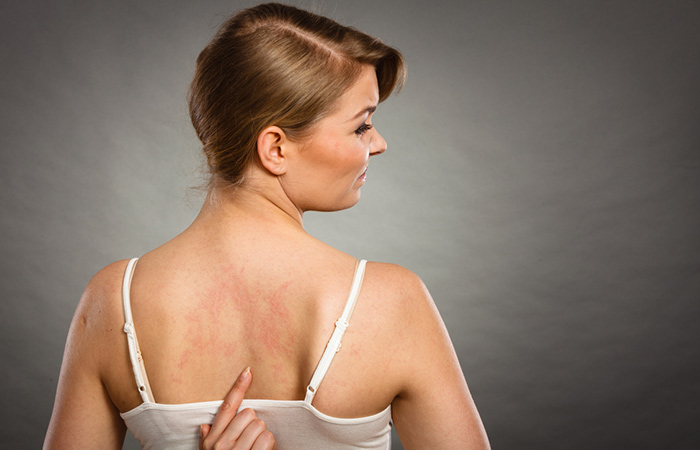 Woman with eczema may benefit from neem