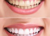 Hydrogen Peroxide For Teeth Whitening - 6 Home Remedies