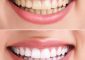 Hydrogen Peroxide For Teeth Whitening - 6...