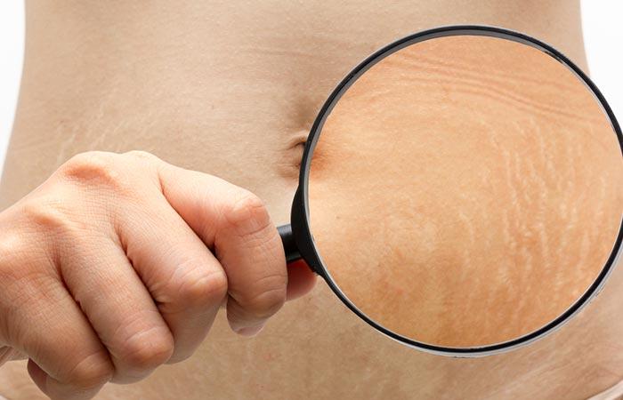 Масло марулы может предотвратить появление растяжек