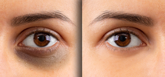 Before and after images of using castor oil on dark circles