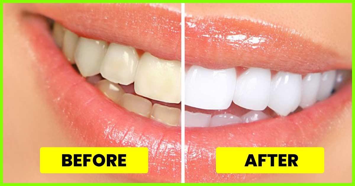 15 Simple Ways To Get White Teeth Overnight