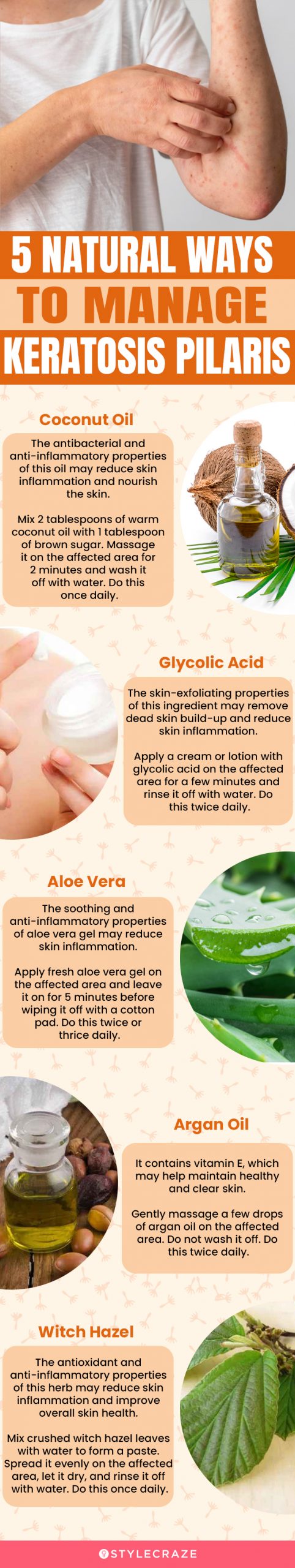 5 natural ways to manage keratosis pilaris (infographic)