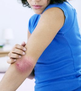 8-Best-Homeopathy-Treatments-For-Psoriasis