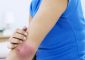 8 Best Homeopathy Treatments For Psoriasis