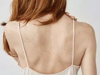 How To Get Rid Of Tinea Versicolor - 15 Home Remedies To Try