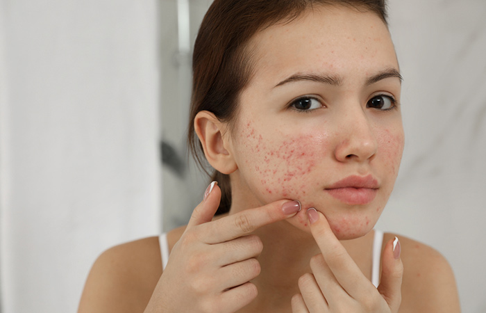 Woman experiencing acne as a side effect of chasteberry