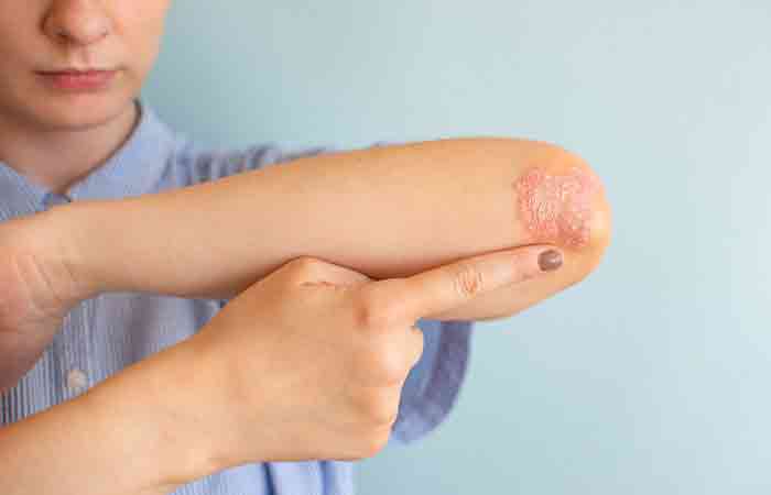 Woman with psoriasis on her elbow