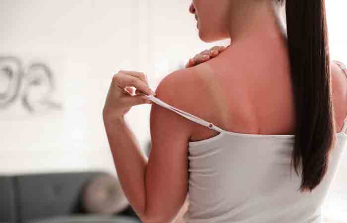 Woman showing sunburnt skin