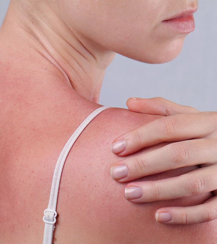 Sun Poisoning: Symptoms, Causes, And Treatment