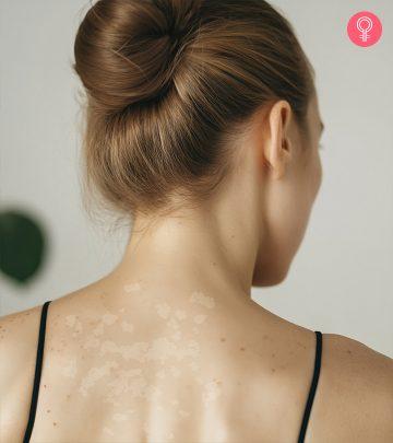 Home Remedies For Tinea Versicolor