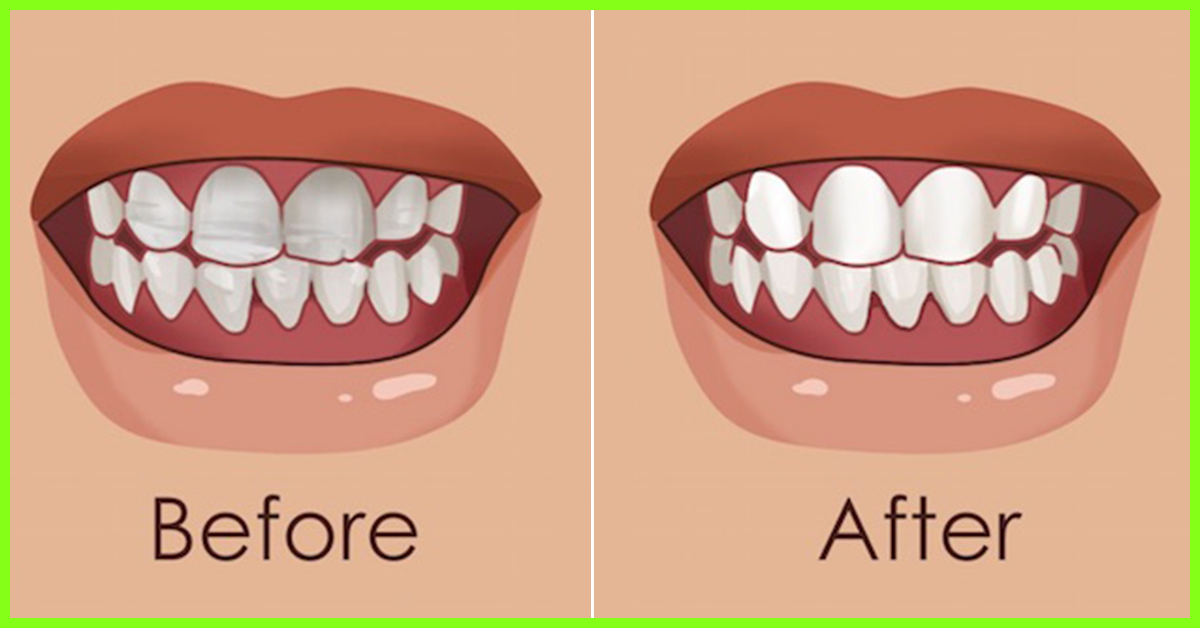 For home teeth remedies strong How To