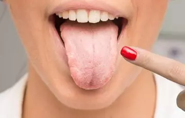 Woman with yeast infection in mouth