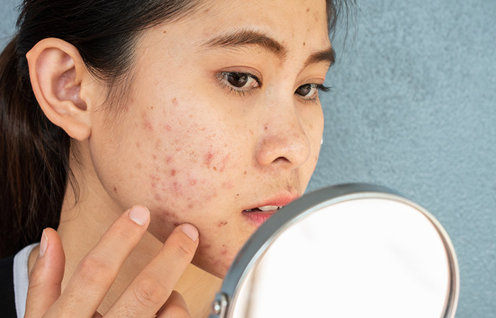 Close up of a woman checking her breakouts caused by topical aspirin.