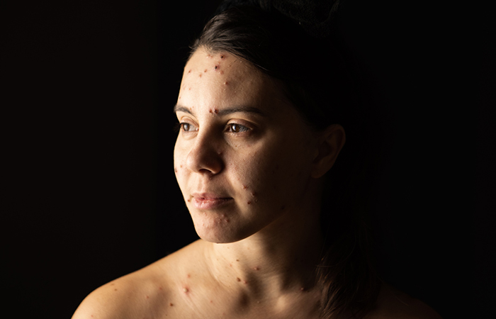 Woman with chicken pox during the summer months