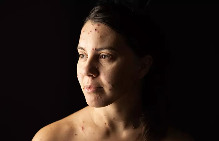 Woman with chicken pox during the summer months