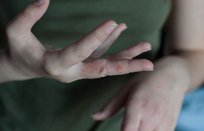 Woman's fingers infected with scabies.