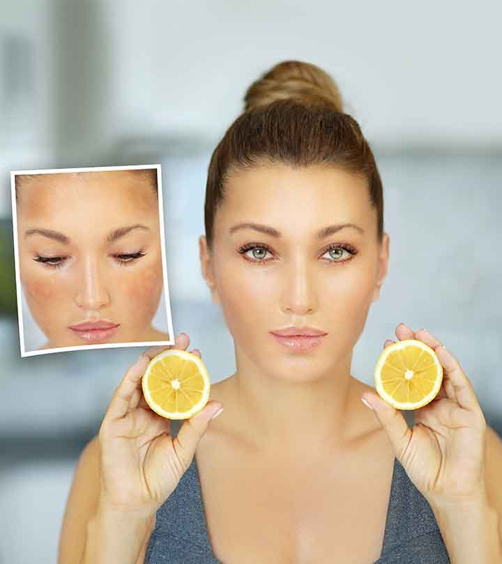 9 Home Remedies To Remove Dark Spots On Face With Lemon Juice