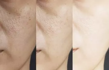 Woman's face before and after using glutathione for skin brightening