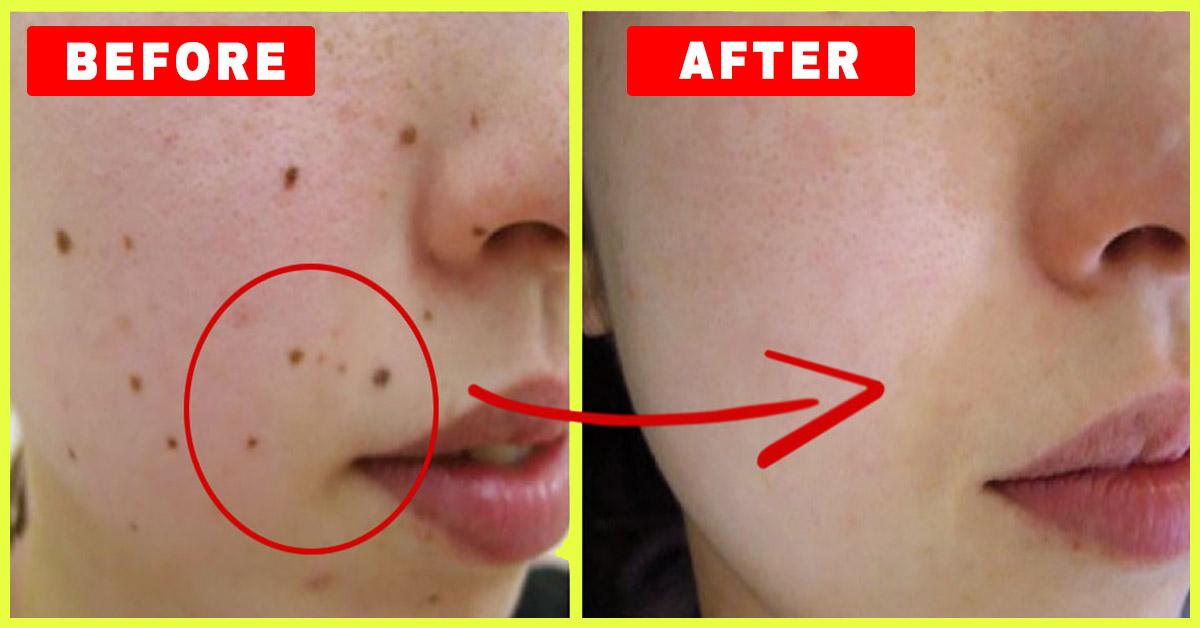 Get rid of moles on skin information | Dernasam