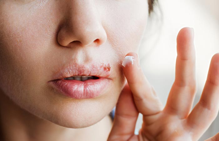Glycerin may treat mouth ulcers and cold sores