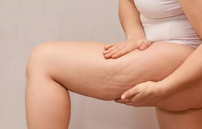 Woman showing cellulite on her thigh