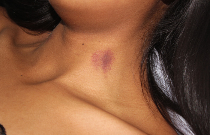 Woman with hickey on the neck