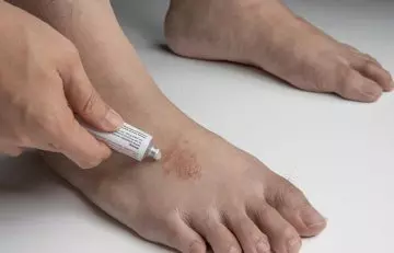 Person applying antifungal ointment on foot