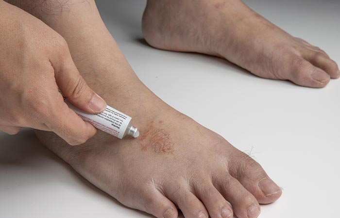 Person applying antifungal ointment on foot