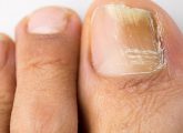How To Use Hydrogen Peroxide For Nail Fungus – A Step By Step ...