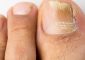 How To Use Hydrogen Peroxide For Nail...