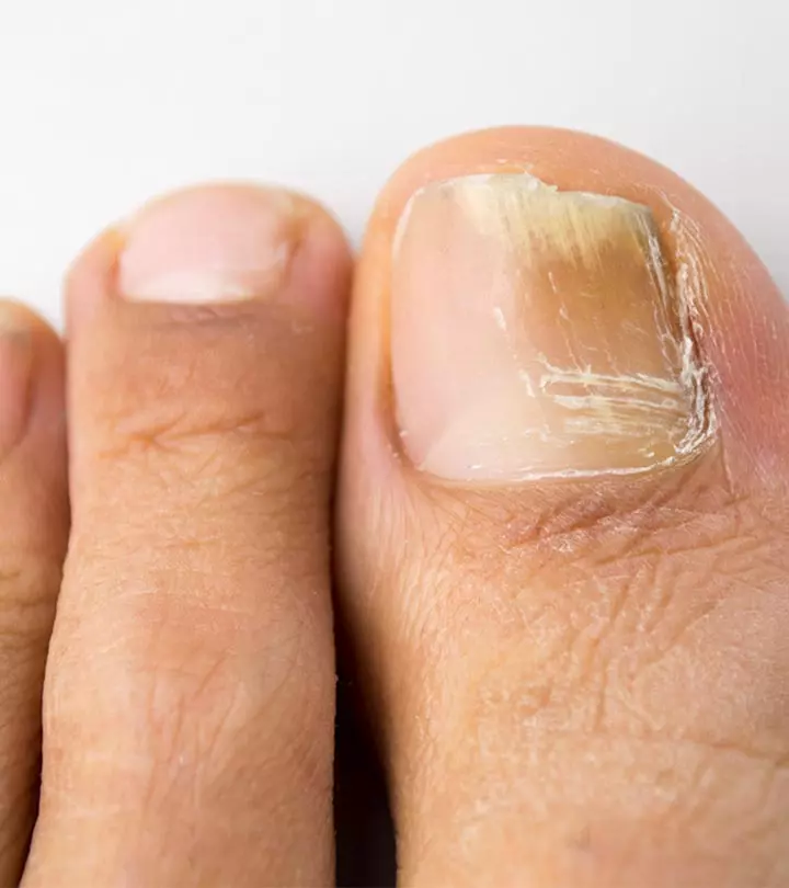 Understand how to use this oxidative therapy to improve your nail health.