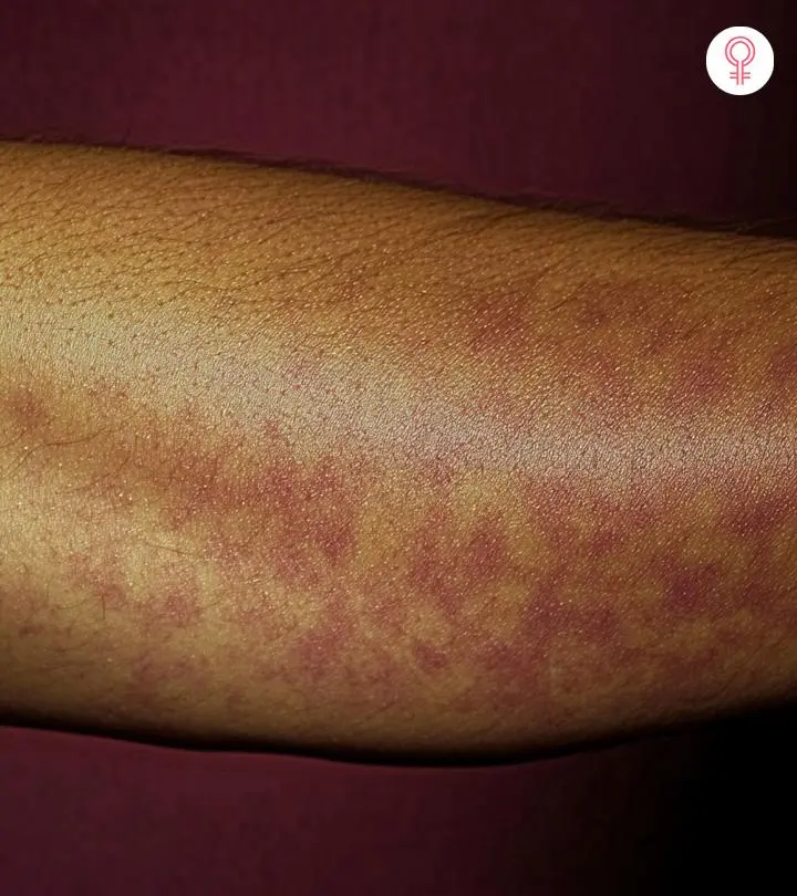 Symptoms Of Mottled Skin