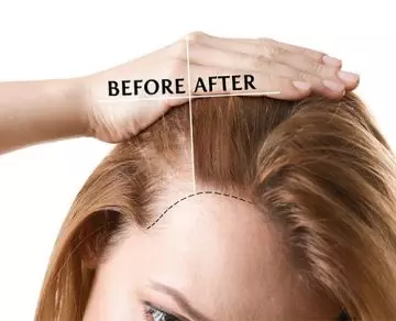 Make thin hair look thicker with hair plugs and implants