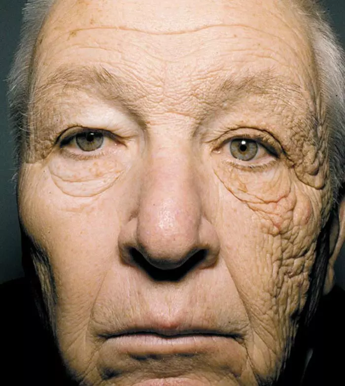 Dermatoheliosis